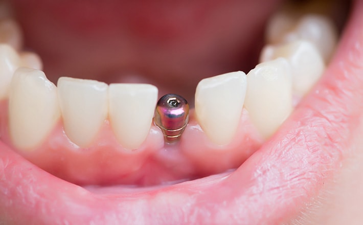 歯を失ったら治療の選択肢にインプラントを　イメージ画像